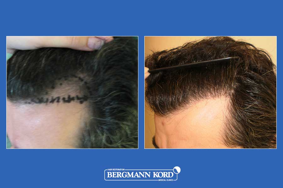 hair-transplantation-bergmann-kord-results-men-33033PG-before-after-003