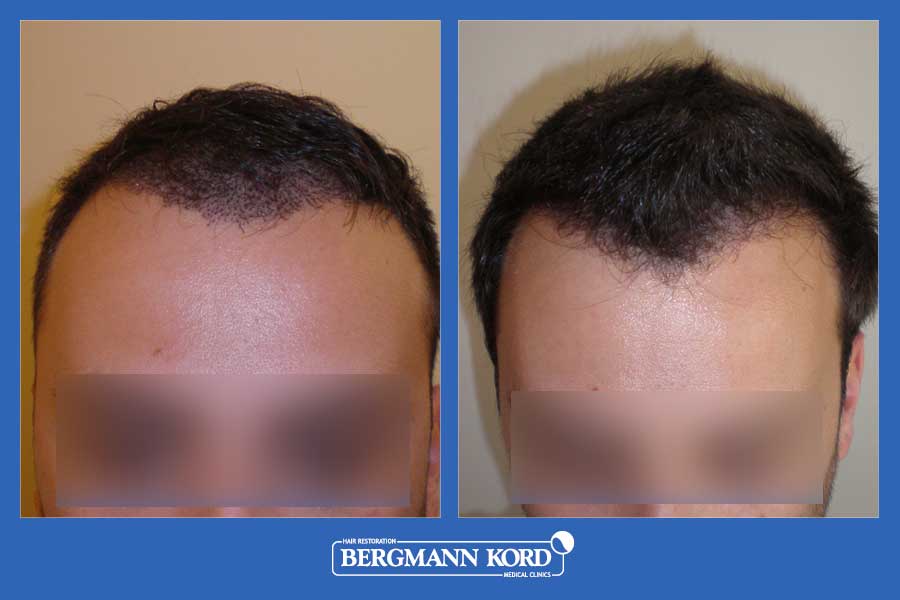 hair-transplantation-bergmann-kord-results-men-33069PG-before-after-001