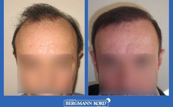 hair-transplantation-bergmann-kord-results-men-35068PG-before-after-001