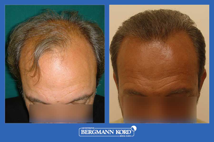 hair-transplantation-bergmann-kord-results-men-36001PG-before-after-001