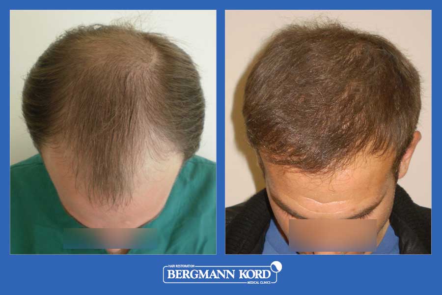 hair-transplantation-bergmann-kord-results-men-39049PG-before-after-002