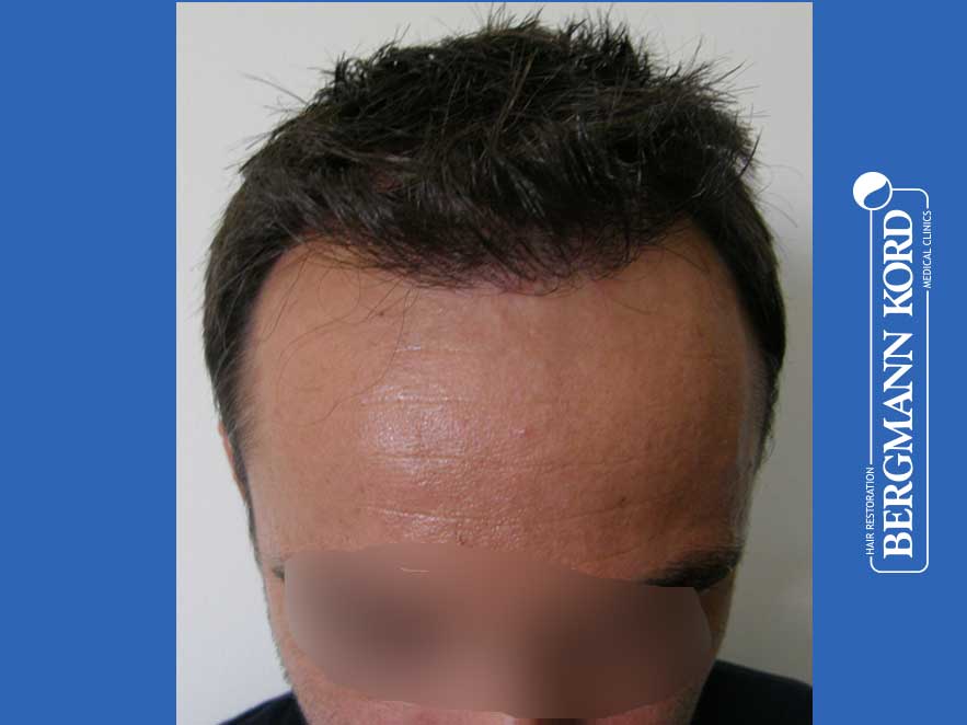 hair-transplantation-bergmann-kord-results-men-41035PG-after-top-001