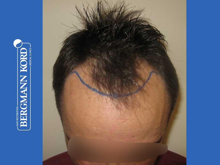 hair-transplantation-bergmann-kord-results-men-41035PG-before-top-001