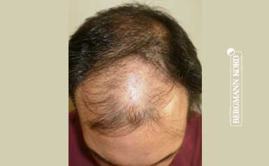 hair-transplantation-bergmann-kord-results-men-41042PG-thumb-001