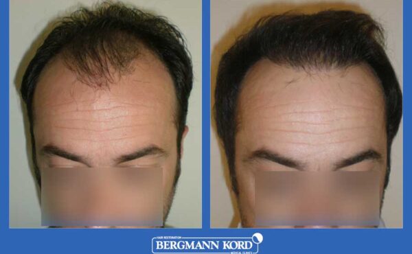 hair-transplantation-bergmann-kord-results-men-42087PG-before-after-001