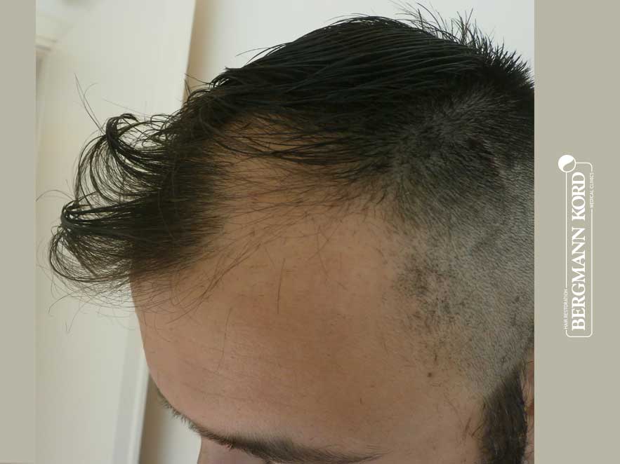 hair-transplantation-bergmann-kord-results-men-43006PG-before-left-001