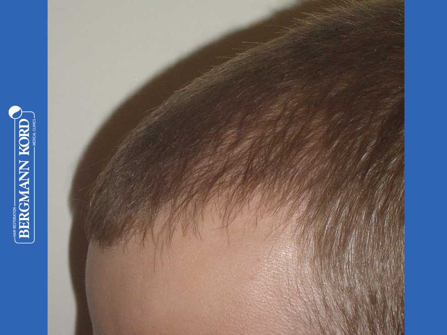 hair-transplantation-bergmann-kord-results-men-43014PG-after-left-001