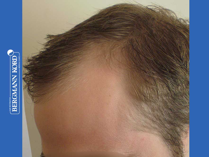 hair-transplantation-bergmann-kord-results-men-43014PG-before-left-001