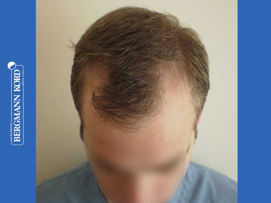 hair-transplantation-bergmann-kord-results-men-43014PG-before-top-001