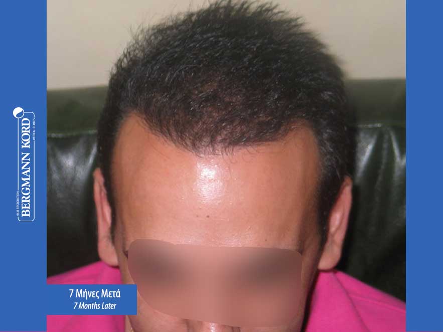 hair-transplantation-bergmann-kord-results-men-44039PG-7months-top-001
