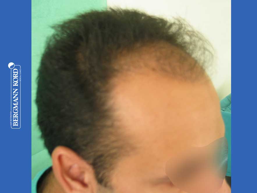 hair-transplantation-bergmann-kord-results-men-44039PG-before-right-001