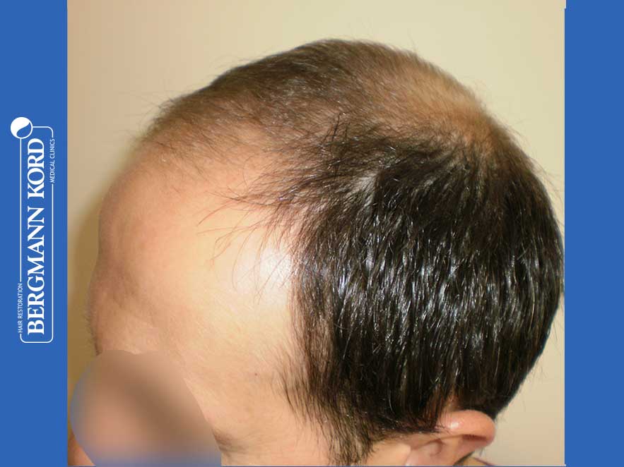 hair-transplantation-bergmann-kord-results-men-44056PG-before-left-001