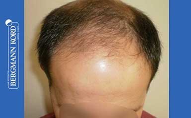 hair-transplantation-bergmann-kord-results-men-44056PG-thumb-001