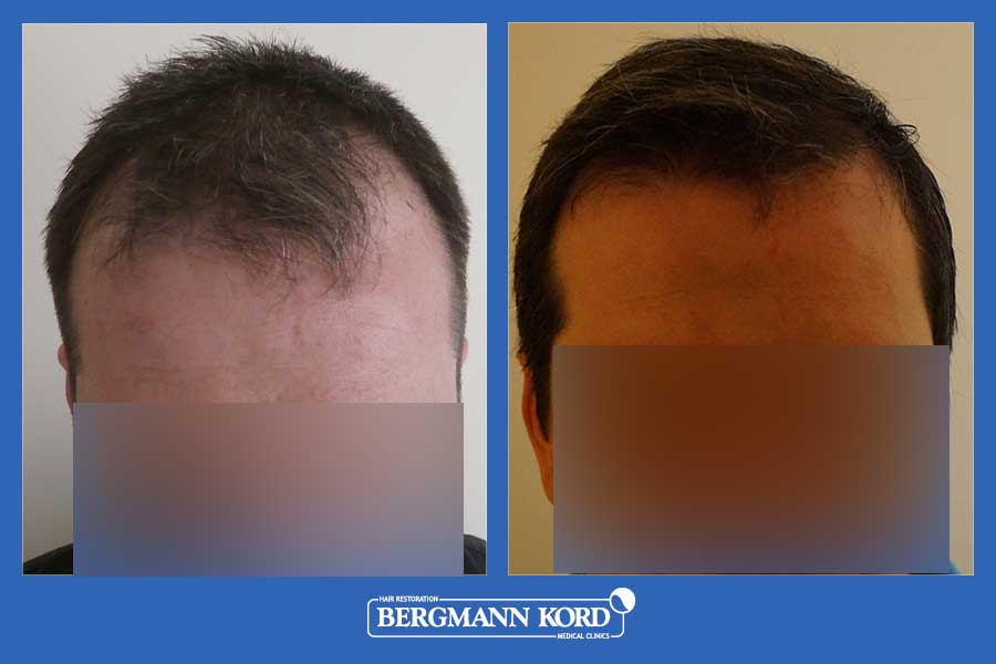 hair-transplantation-bergmann-kord-results-men-44257PG-before-after-001