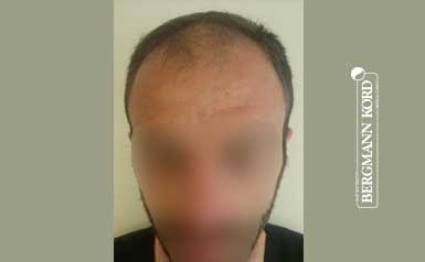 hair-transplantation-bergmann-kord-results-men-45023PG-thumbnail-001