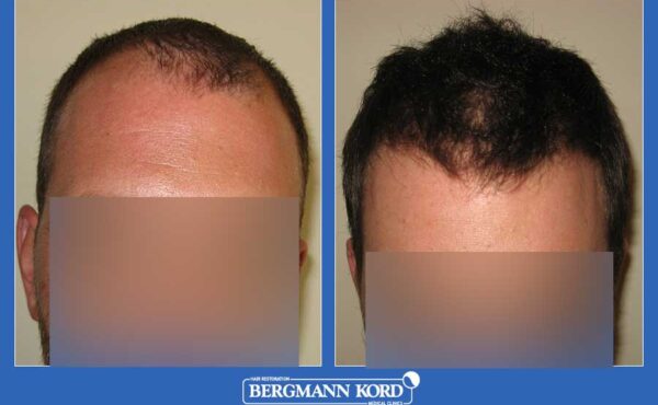hair-transplantation-bergmann-kord-results-men-45667PG-before-after-001