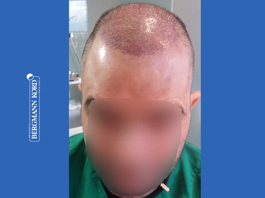 hair-transplantation-bergmann-kord-results-men-48009PG-this-day-front-001