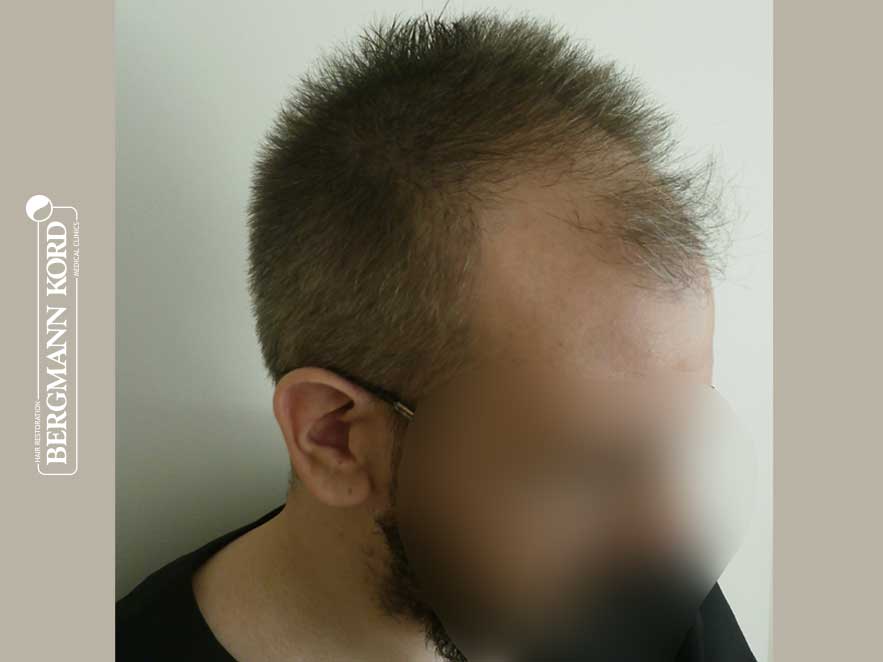 hair-transplantation-bergmann-kord-results-men-49048PG-before-right-001