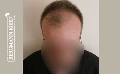 hair-transplantation-bergmann-kord-results-men-49048PG-thumbnail-001