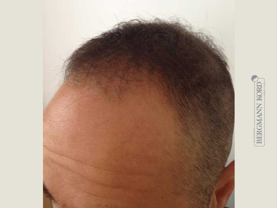 hair-transplantation-bergmann-kord-results-men-51003PG-before-left-001