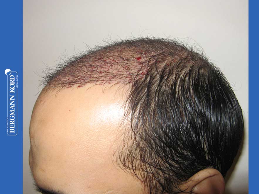 hair-transplantation-bergmann-kord-results-men-51024PG-before-left-001