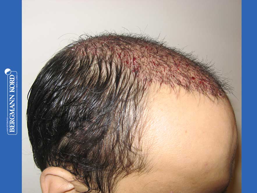 hair-transplantation-bergmann-kord-results-men-51024PG-before-right-001