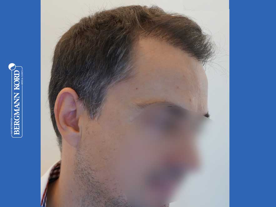 hair-transplantation-bergmann-kord-results-men-52016PG-after-right-001