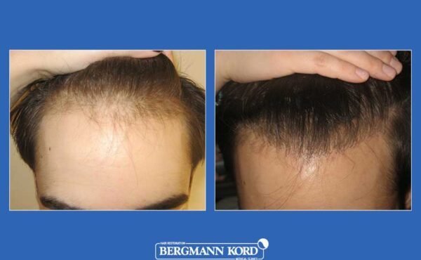 hair-transplantation-bergmann-kord-results-men-52172PG-before-after-001