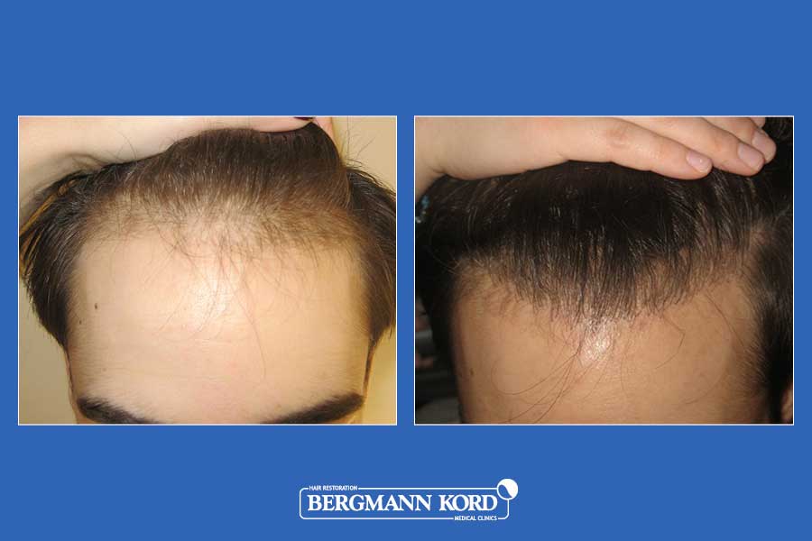 hair-transplantation-bergmann-kord-results-men-52172PG-before-after-001