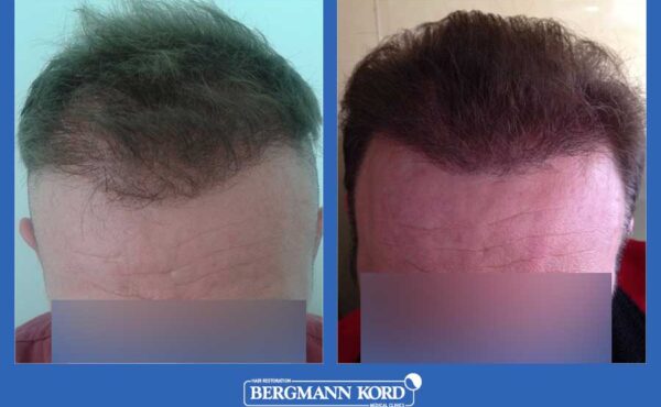 hair-transplantation-bergmann-kord-results-men-52259PG-before-after-001