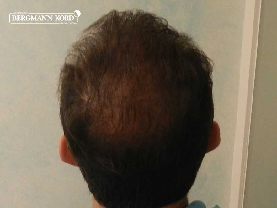 hair-transplantation-bergmann-kord-results-men-53012PG-after-back-001