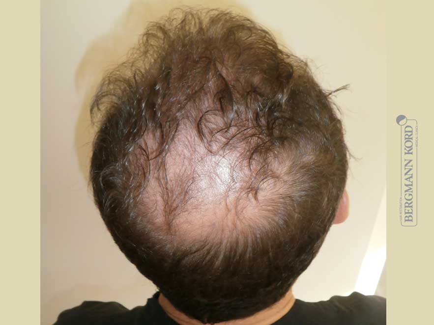 hair-transplantation-bergmann-kord-results-men-53012PG-before-back-001