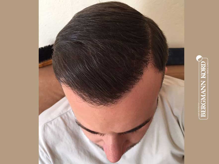 hair-transplantation-bergmann-kord-results-men-53046PG-after-front-001