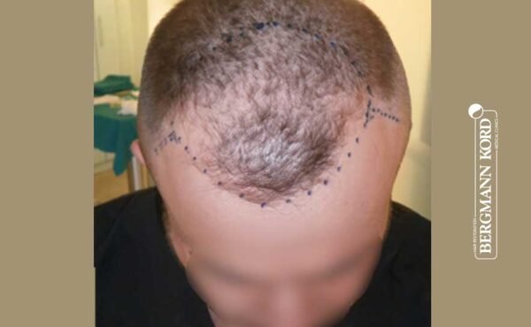 hair-transplantation-bergmann-kord-results-men-53046PG-before-front-001