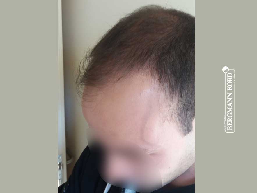 hair-transplantation-bergmann-kord-results-men-55008PG-before-left-001
