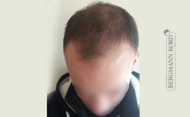 hair-transplantation-bergmann-kord-results-men-55008PG-thumb-001