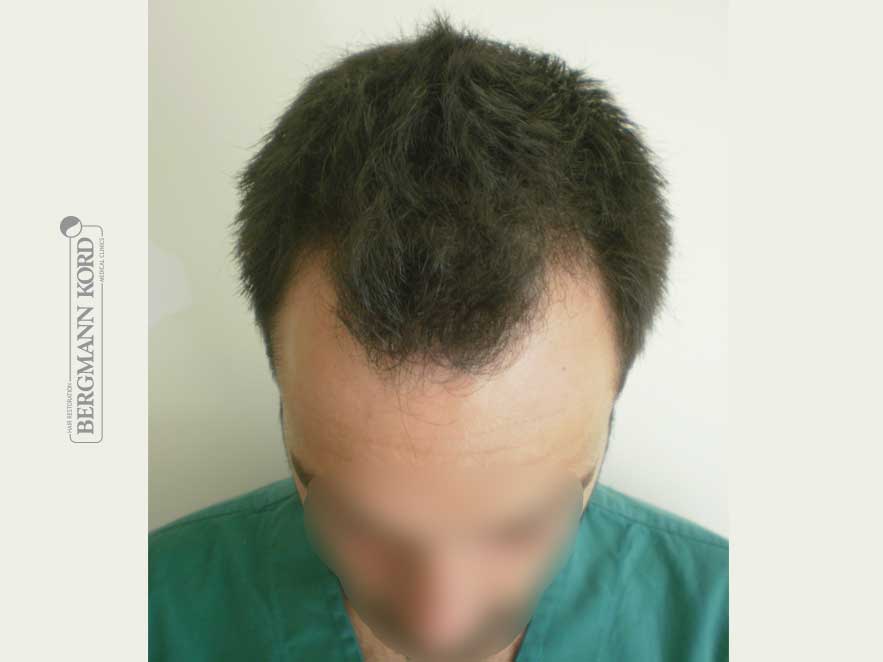 hair-transplantation-bergmann-kord-results-men-56022PG-before-top-001
