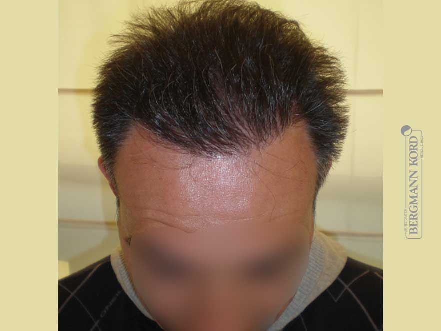 hair-transplantation-bergmann-kord-results-men-56037PG-after-top-001