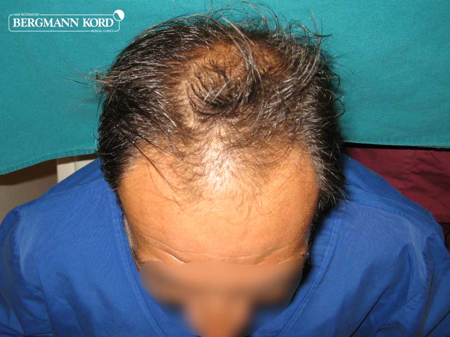 hair-transplantation-bergmann-kord-results-men-56037PG-before-top-001