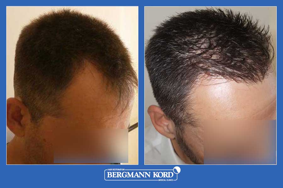 hair-transplantation-bergmann-kord-results-men-56047PG-before-after-001