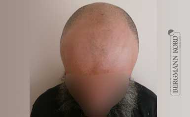 hair-transplantation-bergmann-kord-results-men-57005PG-thumb-001