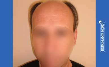 hair-transplantation-bergmann-kord-results-men-57045PG-thumb-001