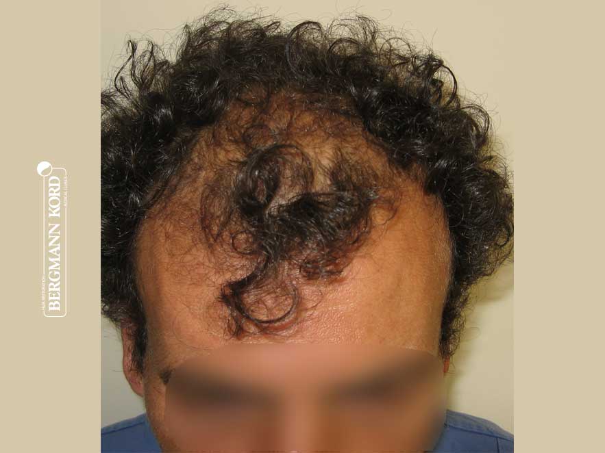 hair-transplantation-bergmann-kord-results-men-58031PG-before-top-001
