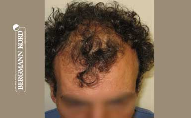 hair-transplantation-bergmann-kord-results-men-58031PG-thumb-001