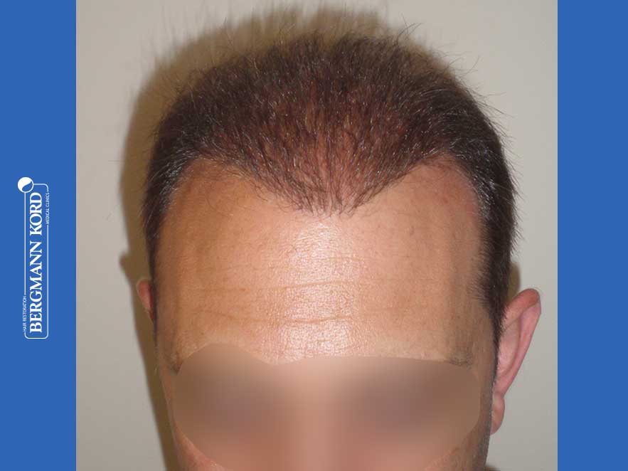 hair-transplantation-bergmann-kord-results-men-58054PG-10months-001