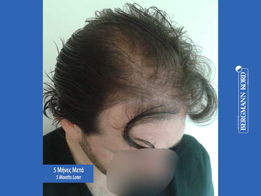 hair-transplantation-bergmann-kord-results-men-59033PG-5months-right-001