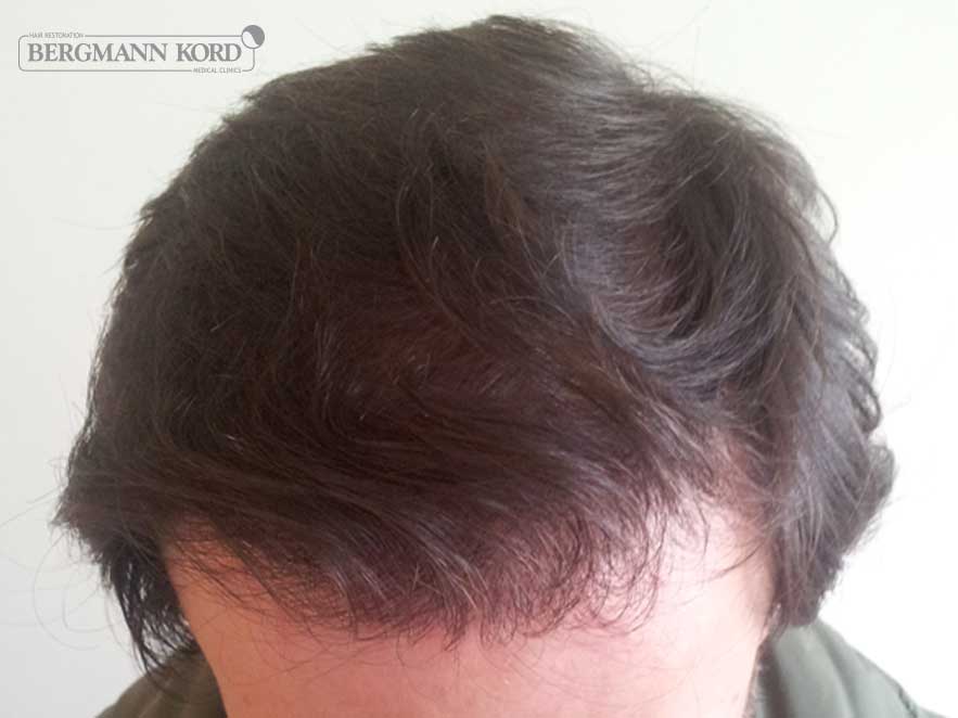 hair-transplantation-bergmann-kord-results-men-59033PG-after-top-001