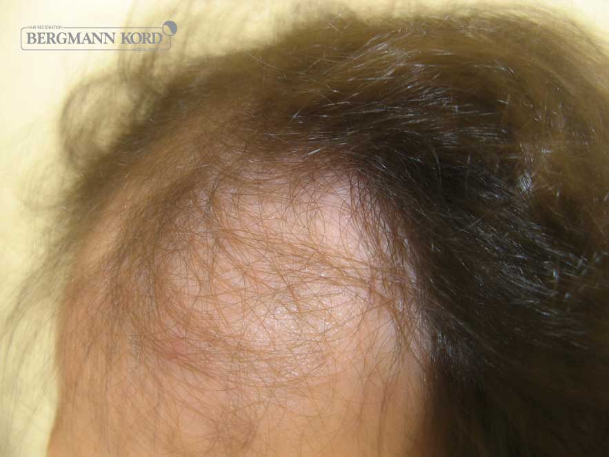hair-transplantation-bergmann-kord-results-men-59033PG-before-left-001