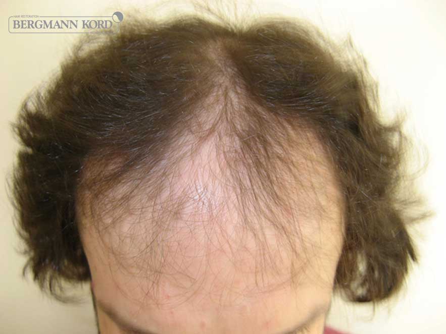 hair-transplantation-bergmann-kord-results-men-59033PG-before-top-001
