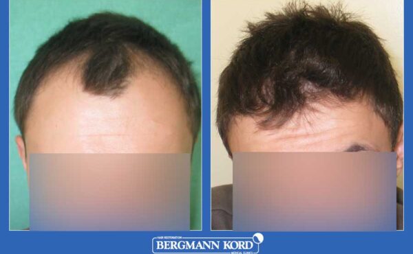 hair-transplantation-bergmann-kord-results-men-59587PG-before-after-001
